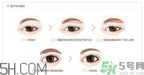 切眉手術(shù)后老得快嗎？切眉能保持多久？