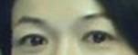 提眉術(shù)后多久可以恢復(fù)？提眉術(shù)后全過程照片