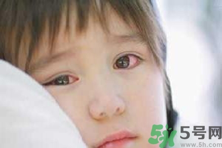 流行性腮腺炎的表現(xiàn)有哪些？?流行性腮腺炎飲食怎么調(diào)理？