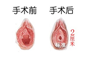 處女膜修補(bǔ)術(shù)效果怎么樣？處女膜修復(fù)手術(shù)有風(fēng)險(xiǎn)嗎？