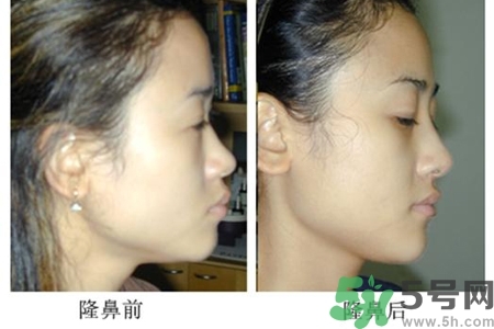 玻尿酸隆鼻的危害有哪些？玻尿酸隆鼻的副作用是什么？