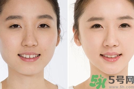 玻尿酸隆鼻的危害有哪些？玻尿酸隆鼻的副作用是什么？