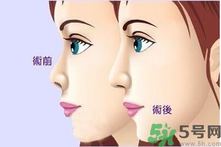 玻尿酸隆鼻的缺點是什么？玻尿酸隆鼻的優(yōu)點有哪些？