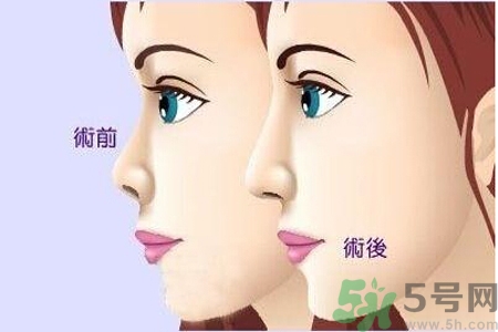 玻尿酸隆鼻和手術(shù)隆鼻的區(qū)別是什么？