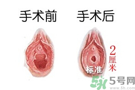 處女膜修補(bǔ)術(shù)效果怎么樣？處女膜修復(fù)手術(shù)有風(fēng)險(xiǎn)嗎？