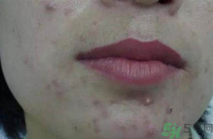 什么樣的痘痘能擠？哪些痘痘不能擠？