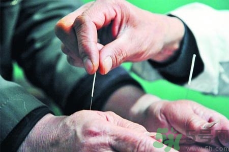 針灸一次要扎多長時(shí)間？針灸可以幾天做一次？