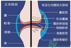 骨關(guān)節(jié)炎能治好嗎？骨關(guān)節(jié)炎平時(shí)注意事項(xiàng)
