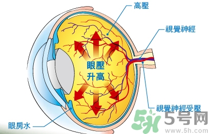 青光眼可以治愈嗎？青光眼怎樣治療？