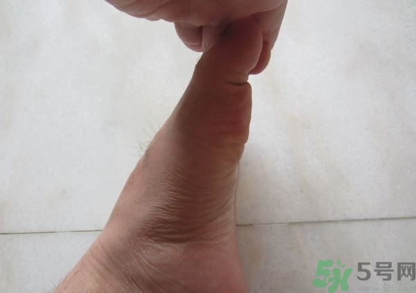 腳拇指外翻遺傳嗎？腳拇指外翻怎么矯正？