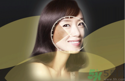 曬斑可以自己消退嗎？曬斑可以用激光去除嗎？