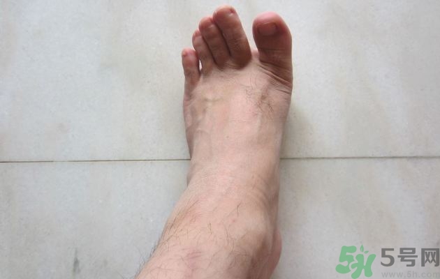 腳拇指外翻遺傳嗎？腳拇指外翻怎么矯正？