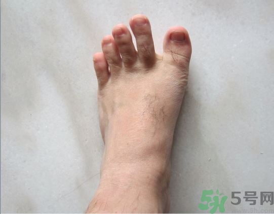 腳拇指外翻遺傳嗎？腳拇指外翻怎么矯正？