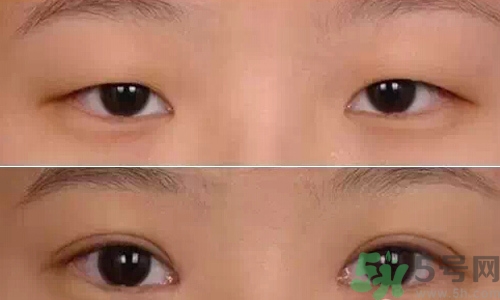天生腫眼泡怎么消除？天生腫眼泡怎么辦？
