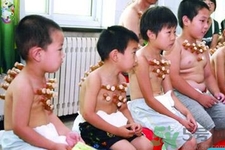 小孩可以拔罐嗎？寶寶能拔火罐嗎？