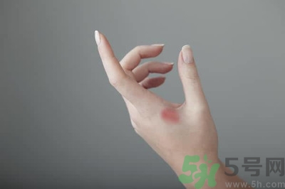 手被燙紅了怎么辦？手被燙了怎么止痛？