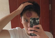 頭痛可以在額頭上拔火罐嗎？額頭上拔火罐有什么好處？