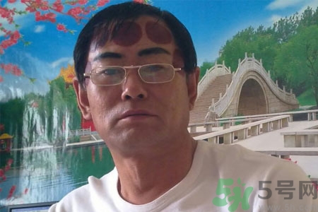 頭痛可以在額頭上拔火罐嗎？額頭上拔火罐有什么好處？