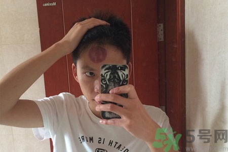 頭痛可以在額頭上拔火罐嗎？額頭上拔火罐有什么好處？