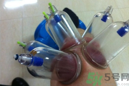 膝蓋能拔罐嗎？膝蓋疼可以拔罐嗎？