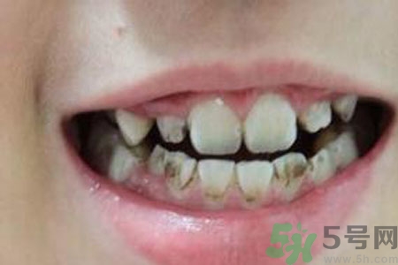小孩牙齒發(fā)黑怎么回事？小孩牙齒發(fā)黑怎么辦？