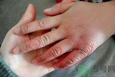 凍瘡為什么容易復(fù)發(fā)？?jī)霪彿磸?fù)發(fā)作怎么辦？