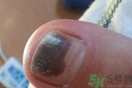 腳趾甲變黑是什么原因？腳趾甲變黑是怎么回事？