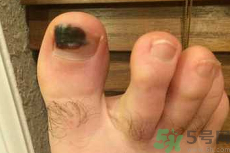 腳趾甲變黑是什么原因？腳趾甲變黑是怎么回事？