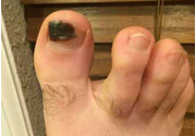 腳趾甲變黑是什么原因？腳趾甲變黑是怎么回事？