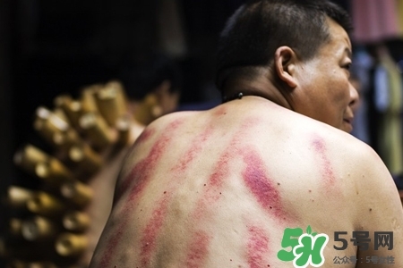 背部刮痧后能拔火罐嗎？背部刮痧后拔火罐有什么好處？