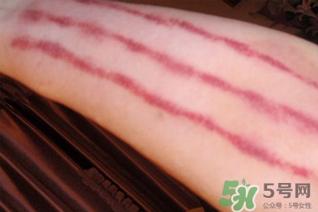 揪痧和刮痧哪個效果比較好？揪痧和刮痧的區(qū)別？