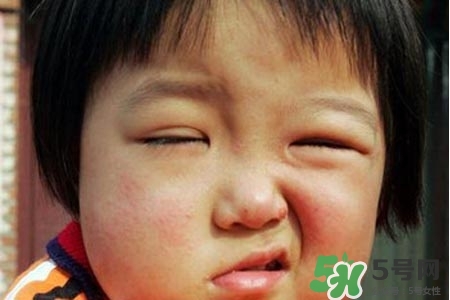 青少年面癱是怎么回事？青少年面癱是怎么辦？
