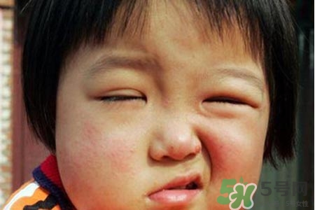 鼻炎會(huì)引起面癱嗎？鼻炎為什么會(huì)導(dǎo)致面癱？