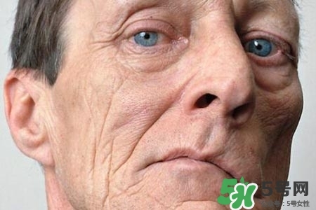 老年人為什么容易得面癱？老年人面癱原因有哪些？