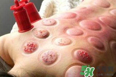 拔罐放血對身體好嗎？拔罐放血有什么好處？