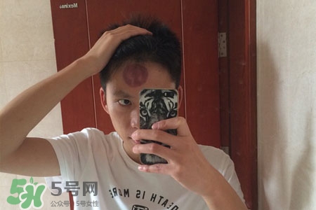 拔罐后皮膚癢能撓嗎？拔罐后身上癢切忌抓撓