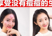 伊詩蘭頓祛痘怎么樣？伊詩蘭頓祛痘膏有用嗎？