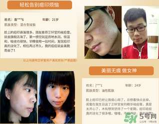 芷軒堂祛痘有效果嗎？芷軒堂祛痘印效果怎么樣？