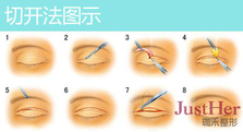 定點(diǎn)雙眼皮怎么做？定點(diǎn)雙眼皮需要拆線嗎？