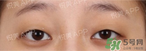 埋線雙眼皮多久恢復(fù)自然？埋線雙眼皮多久能恢復(fù)