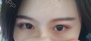 定點(diǎn)雙眼皮能保持多久？定點(diǎn)雙眼皮是永久的嗎？