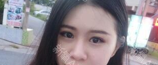 定點(diǎn)雙眼皮能保持多久？定點(diǎn)雙眼皮是永久的嗎？