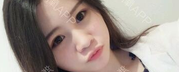 定點(diǎn)雙眼皮能保持多久？定點(diǎn)雙眼皮是永久的嗎？