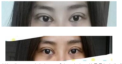 定點(diǎn)雙眼皮怎么做？定點(diǎn)雙眼皮需要拆線嗎？