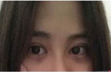 定點(diǎn)雙眼皮怎么做？定點(diǎn)雙眼皮需要拆線嗎？