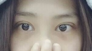 定點(diǎn)雙眼皮怎么做？定點(diǎn)雙眼皮需要拆線嗎？
