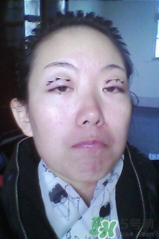 什么是定點雙眼皮？定點雙眼皮多少錢？