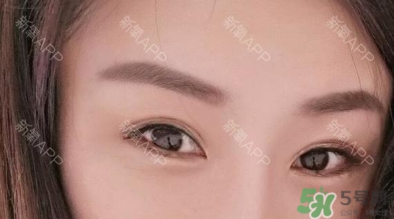 埋線雙眼皮能保持多久？埋線雙眼皮是永久嗎