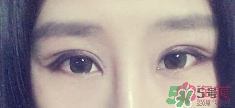 切開(kāi)雙眼皮多久消腫？切開(kāi)雙眼皮多久恢復(fù)？