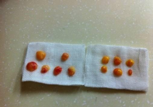 韓式三點雙眼皮是永久嗎？三點雙眼皮能保持多久？